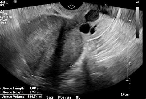 Cervix Nabothian Cysts | Uterus