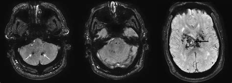 Dentate Nucleus Mri