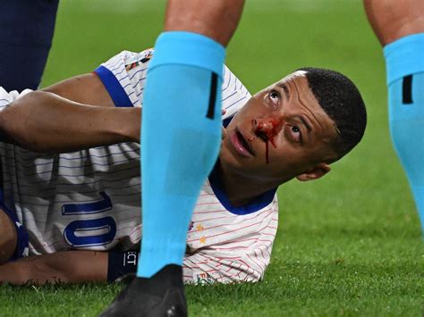 Mbappe Injury Euro 2024 - Kylie Minetta