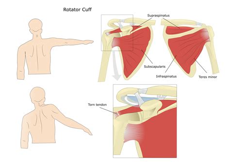 What Is the Rotator Cuff? - Larson Sports and Orthopaedics