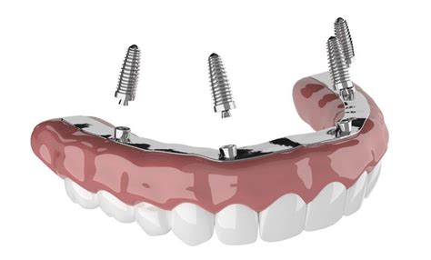 Comparing The Permanent Alternatives to Dentures