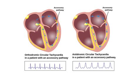 Tachycardia - StoryMD