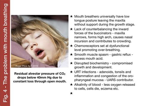 Mouth Breathing, Malocclusion & restoration of nasal breathing | Dental Jay