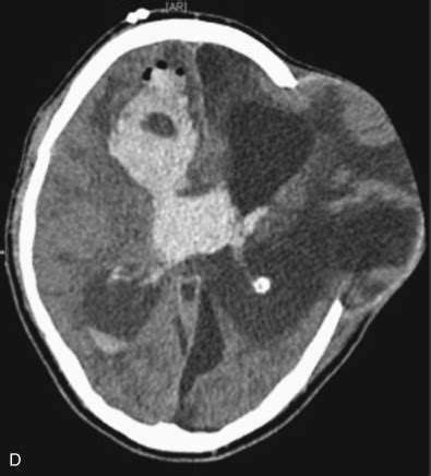 Complications After Decompressive Craniectomy and Cranioplasty | Neupsy Key