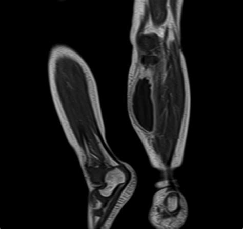 Isolated Subcutaneous Abscess: A Rare Presentation of Extrap... : The ...