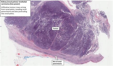 Kidney – Renal pelvis urothelial carcinoma – NUS Pathweb :: NUS Pathweb