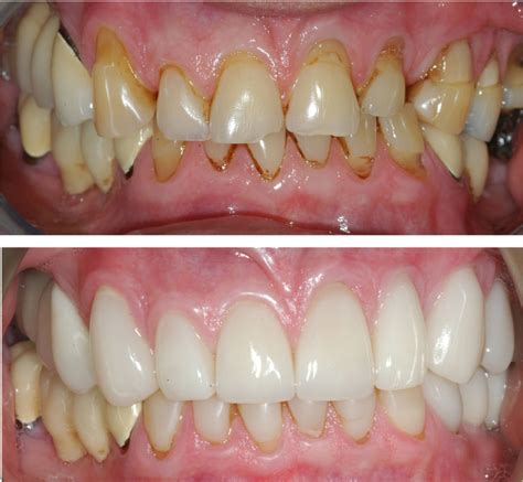 Before and After Dental Treatments – Metropolitan Smiles