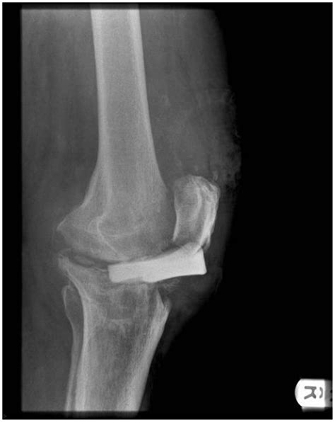 Frontiers | Patella Tendon Injuries Secondary to Cement Spacers Used at First-Stage Revision of ...