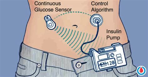 Closed loop insulin pump