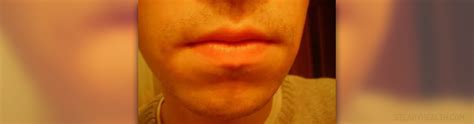 Sunburned lips treatment | General center | SteadyHealth.com