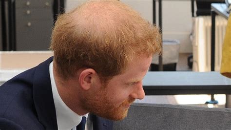 Royal hair: Prince Harry seeks help from clinic as he starts to go bald