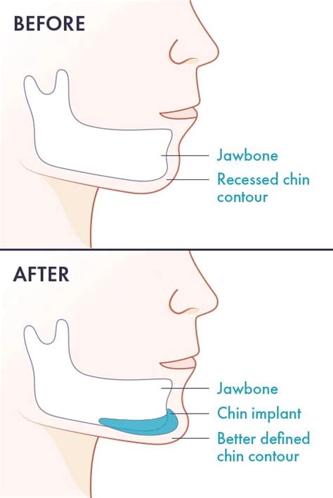 Chin Implant Surgery | ABCS | Jaw Contouring for Men & Women