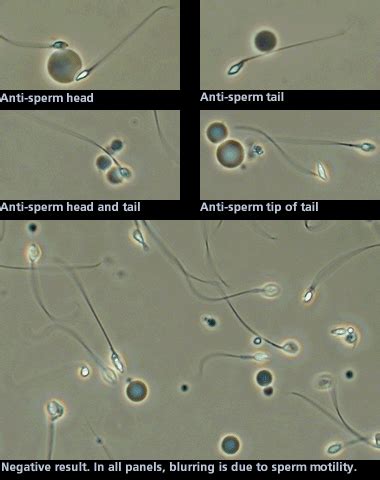 Sperm antibodies treatment – Telegraph