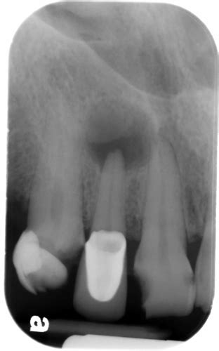 Rarefying Osteitis – Dr. G's Toothpix