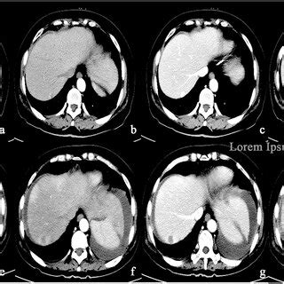 (A-D) A round low-density mass in the right lobe of the liver was shown ...