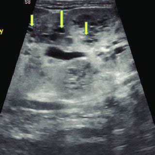 Kidney Lesions On Ultrasound