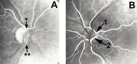 Two fundus photographs. A = This shows a large cilioretinal artery ...