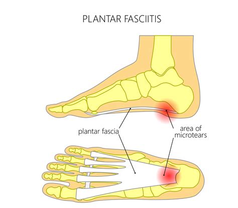 Plantar Fasciitis Diagram - exatin.info