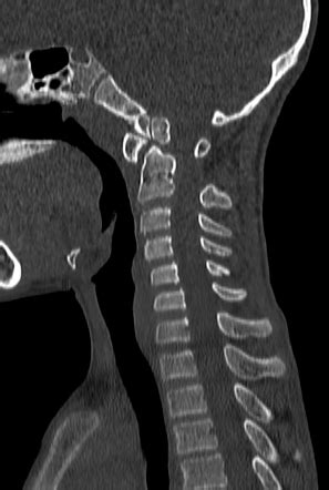 Os odontoideum | Radiology Case | Radiopaedia.org