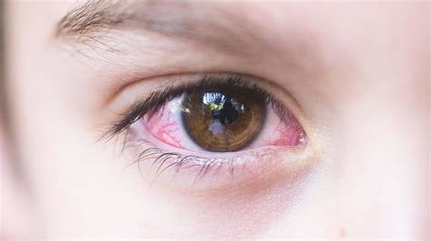 Is it pink eye or an allergy? - TODAY.com