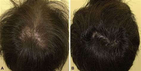 Minoxidil Before And After: Photos & Results | Wimpole Clinic