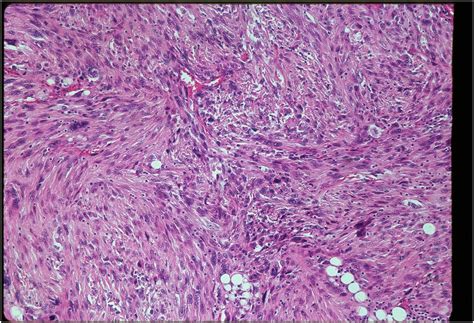 Histiocytoma, Benign Fibrous; Dermatofibroma; Hemangioma, Sclerosing; Histiocytoma, Cutaneous ...