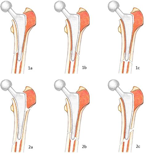 Vancouver Classification System Fracture Classification Vancouver A ...