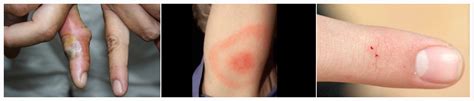 Black Widow Spider Bite: Symptoms and Treatments | New Health Advisor