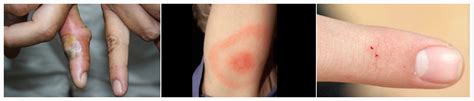 Black Widow Spider Bite: Symptoms and Treatments | New Health Advisor