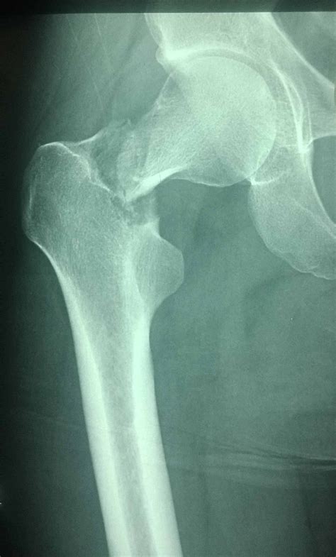 Cureus | Can Three Screws and a Fibula be a Viable Treatment for Managing Neglected Femoral Neck ...