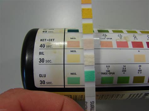 Glucose strip test urine – Telegraph