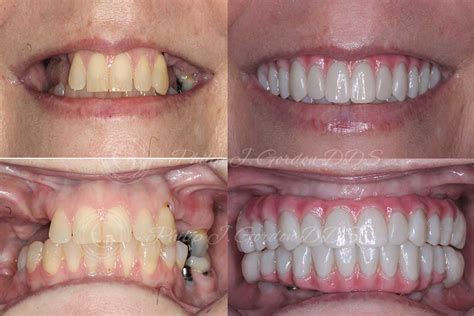 All On 4 Dental Implants Before And After