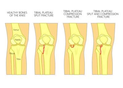 Tibial Plateau Fracture | Orthopedic Knee Specialist | Vail, Aspen, Colorado Springs, Denver ...