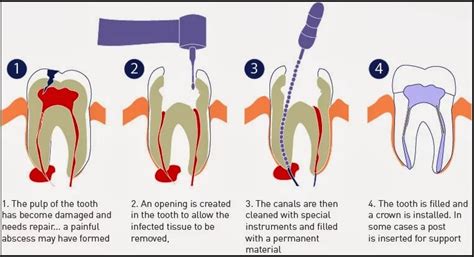 Root Canal Procedures Can Save Teeth in Mississauga | St. Lawrence Dentistry