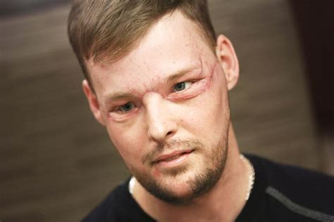 This Man's Face Transplant Story Is Incredibly Inspiring | Allure