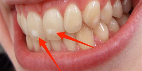 White spots on teeth are related to childhood health - Business Insider