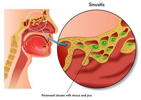 Sinusitis Treatment: Where to Turn - University Health News