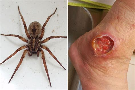 The worst spider bite pictures including the Brown Recluse and Black Widow - Mirror Online