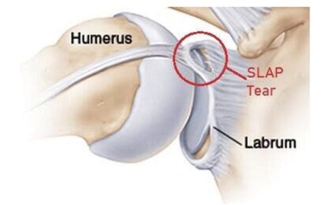 Shoulder Labral Tears - Eastside Medical Group - Cleveland, Ohio