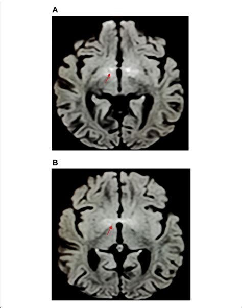 | Hyperintensities in diffusion-weighted imaging at the level of the ...