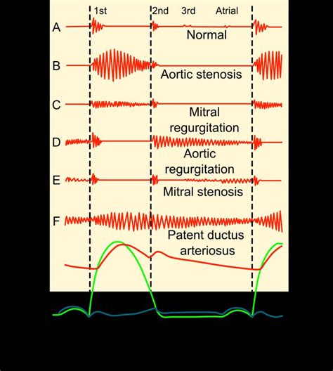 Aortic Valve Murmur Sound