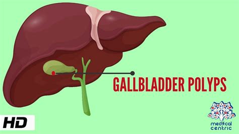 Gallbladder Polyp, Causes, Signs and Symptoms, Diagnosis and Treatment ...