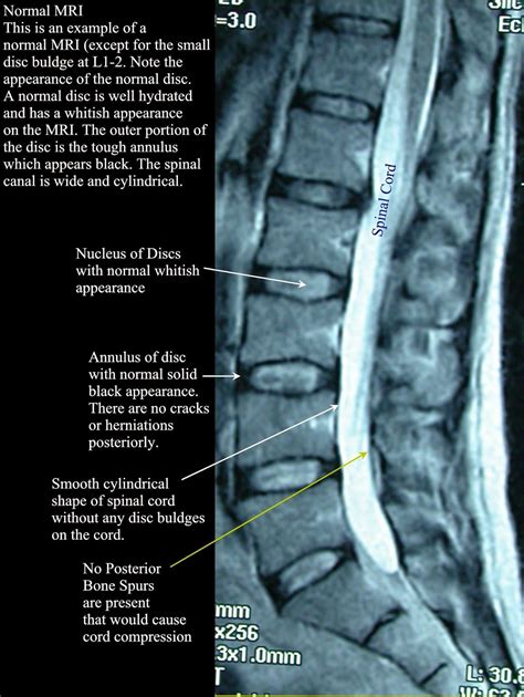 Normal MRI LUmbar | Mri Scans | Pinterest | Hip pain