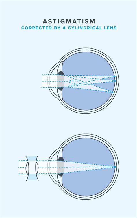 Can You Wear Contacts With Astigmatism? | Warby Parker