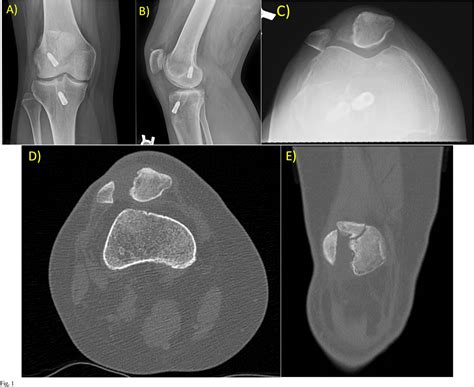 Figure 1 from Management of Patella Fracture Nonunion and Large Bone ...