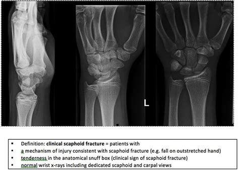 Scaphoid Fracture Mri