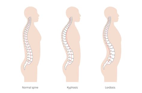 Lordosis Treatment Before After