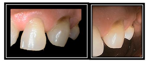 Cervical abrasion injuries in current dentistry - MedCrave online