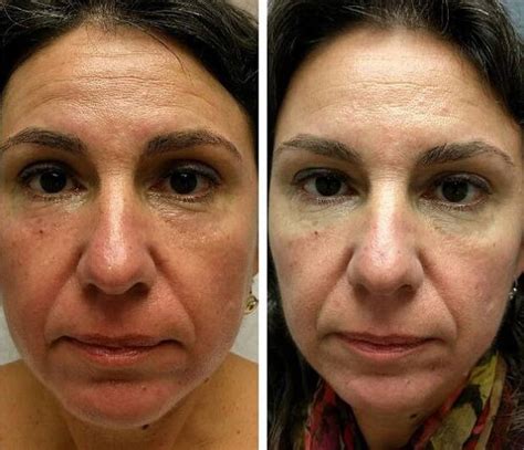 Phymatous Rosacea Nose » Rhinoplasty: Cost, Pics, Reviews, Q&A