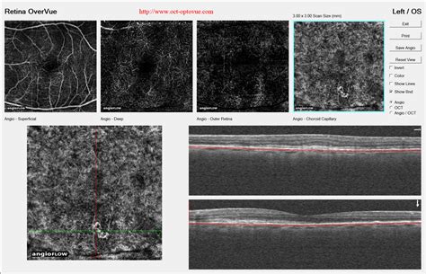 OCT angiography & AMD